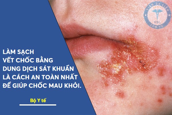 benh_choc_lo bệnh chốc lở