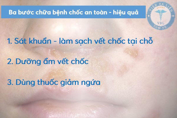 cach_chua_choc_lo_tre_em cách chữa chốc lở trẻ em 