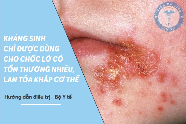 cach_chua_choc_lo_tre_em cách chữa chốc lở trẻ em 