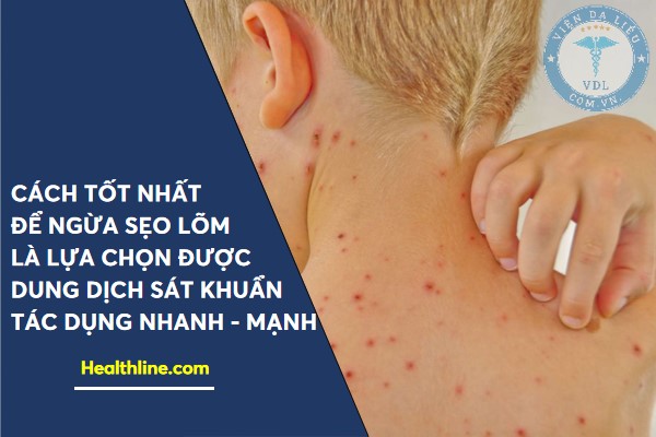 chua_thuy_dau_khong_seo chữa thủy đậu không sẹo 