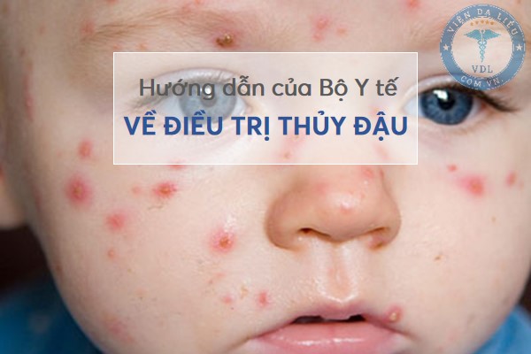 dieu_tri_thuy_dau điều trị thủy đậu