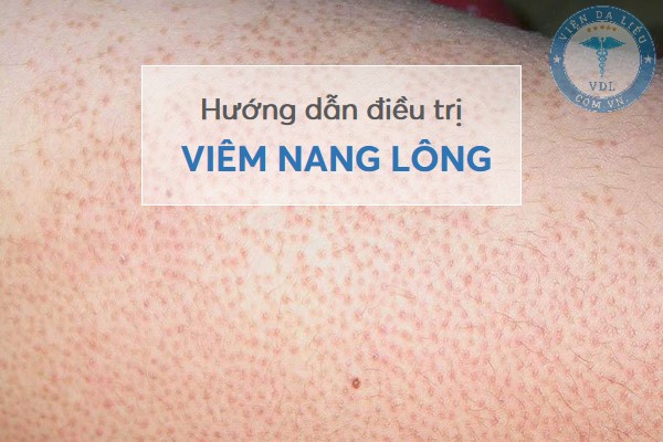 dieu_tri_viem_nang_long điều trị viêm nang lông