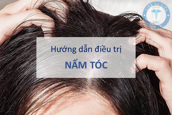 Chi tiết hơn 18 cách trị trứng tóc tại nhà không thể bỏ qua 10 Cách chữa gàu ống vừa đơn giản vừa hiệu quả tại nhà