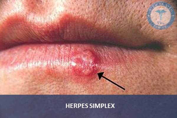 2. Herpes simplex (HSV) 1