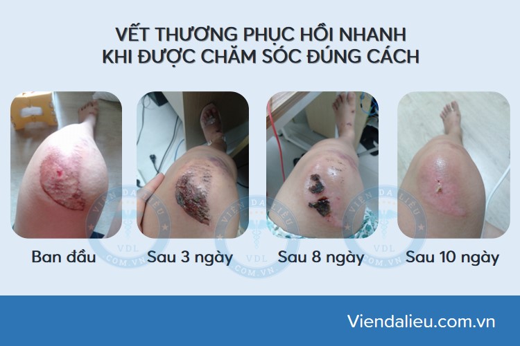 vet-thuong-ho vết thương hở