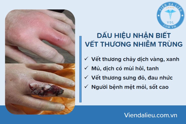 vet-thuong-ho vết thương hở