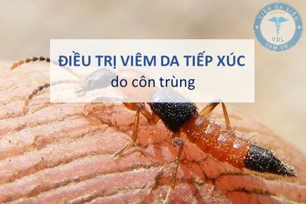 Điều trị viêm da tiếp xúc do côn trùng theo Bộ Y tế hướng dẫn