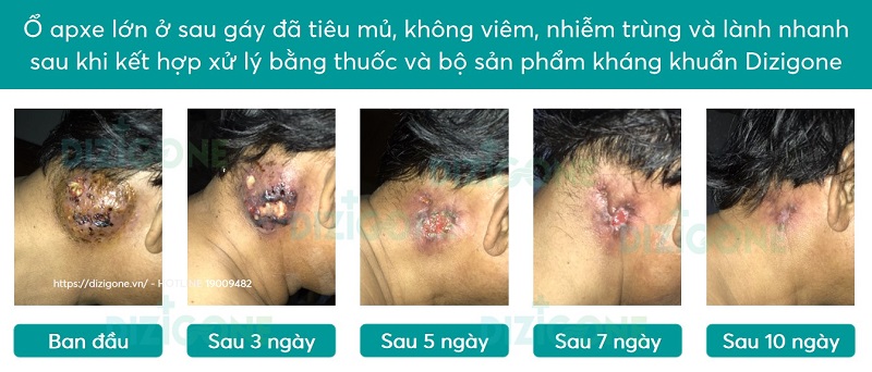 vết thương apxe vet-thuong-apxe