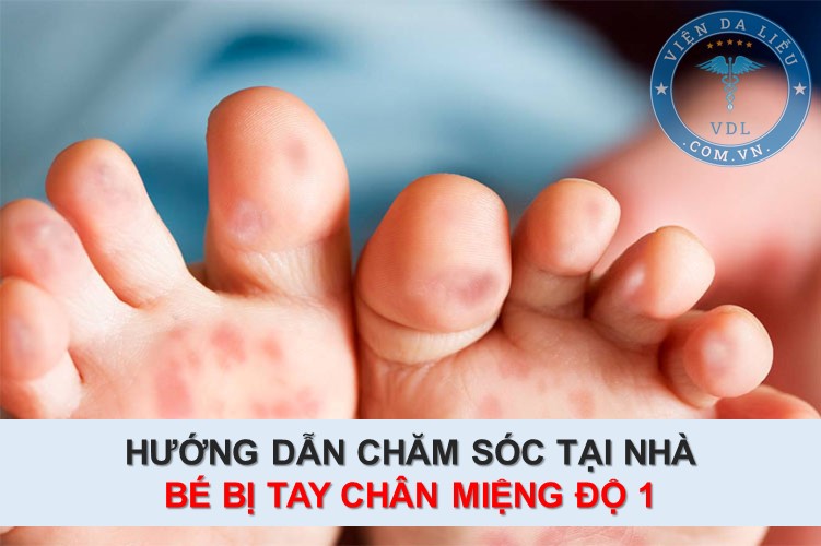 bé bị tay chân miệng độ 1 be-bi-tay-chan-mieng-do-1-0