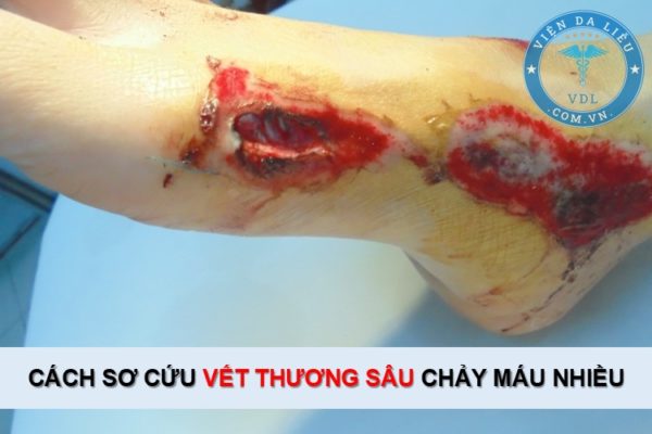 Cách sơ cứu vết thương sâu bị chảy máu nhiều Cách sơ cứu vết thương sâu bị chảy máu nhiều