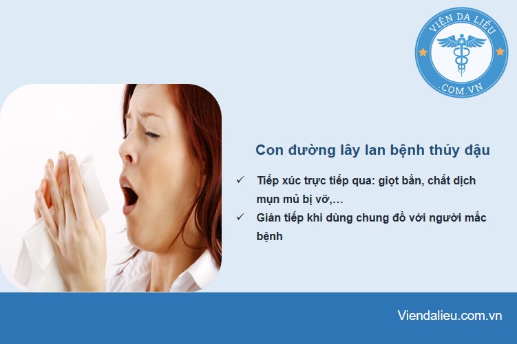 thủy đậu lây lan