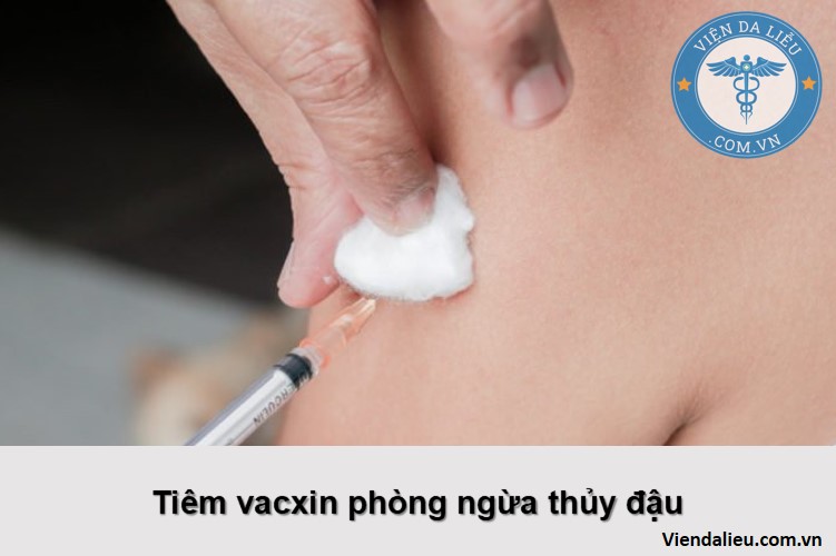 thủy đậu lây lan