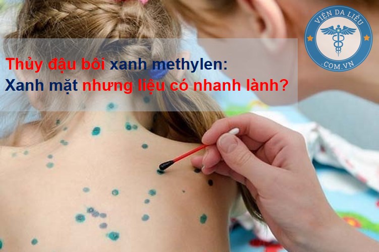 Thủy đậu bôi xanh methylen: Nhuộm bẩn màu da nhưng liệu có nhanh lành? 1