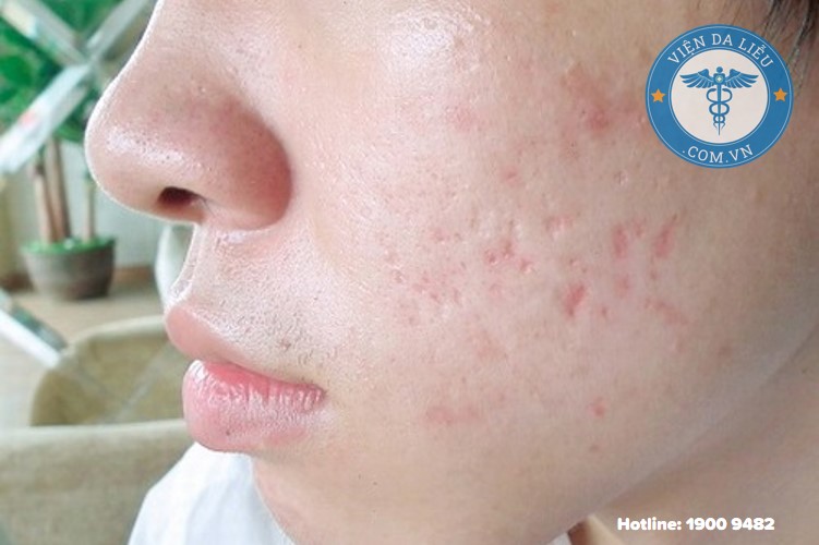 chấm tca trị sẹo lõm