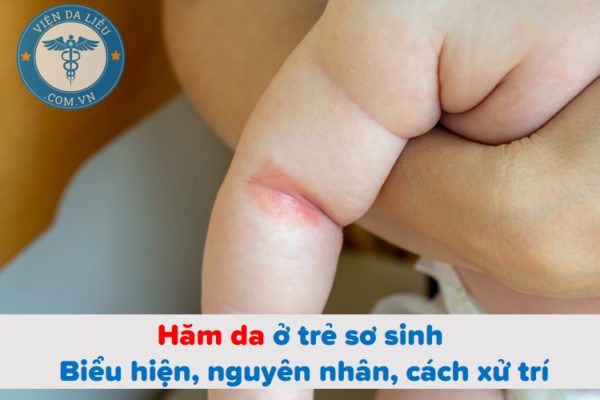 Hăm da ở trẻ sơ sinh: Biểu hiện, nguyên nhân, cách xử trí Hăm da ở trẻ sơ sinh: Biểu hiện, nguyên nhân, cách xử trí