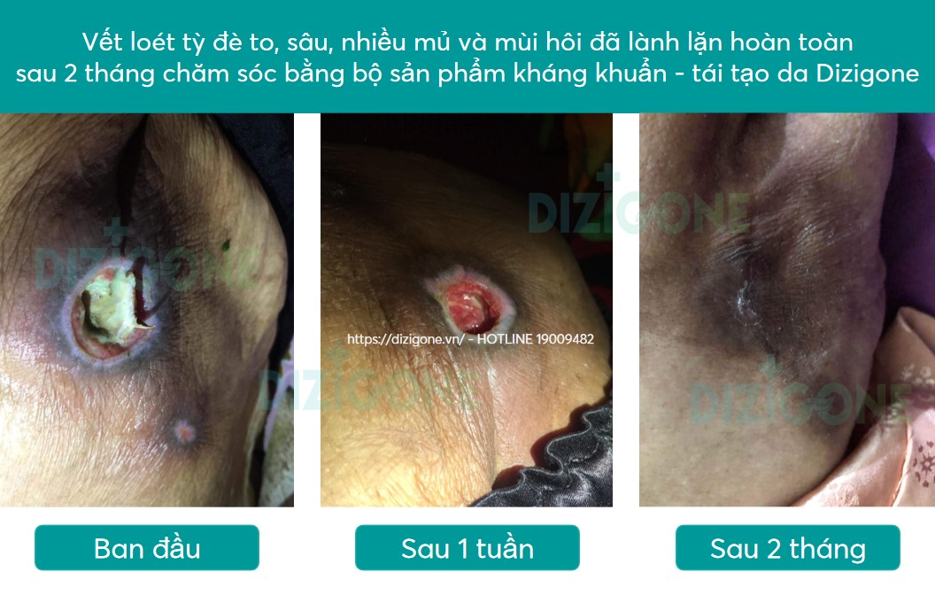 loét tỳ đè loet-ty-de