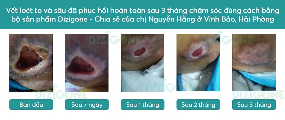 loet ty de loét tỳ đè