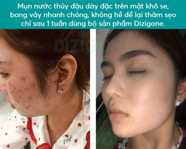 thuy-dau thủy đậu