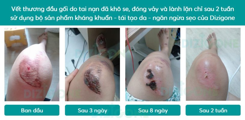 vết thương vet thuong